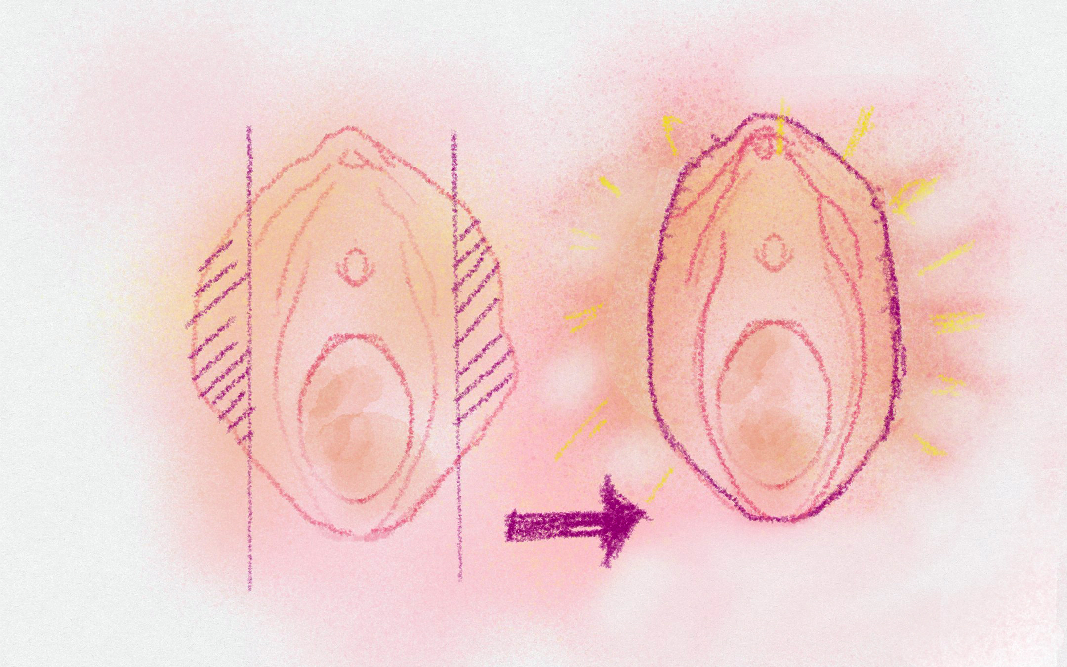 小陰唇形成（縮小）術のイメージ画像