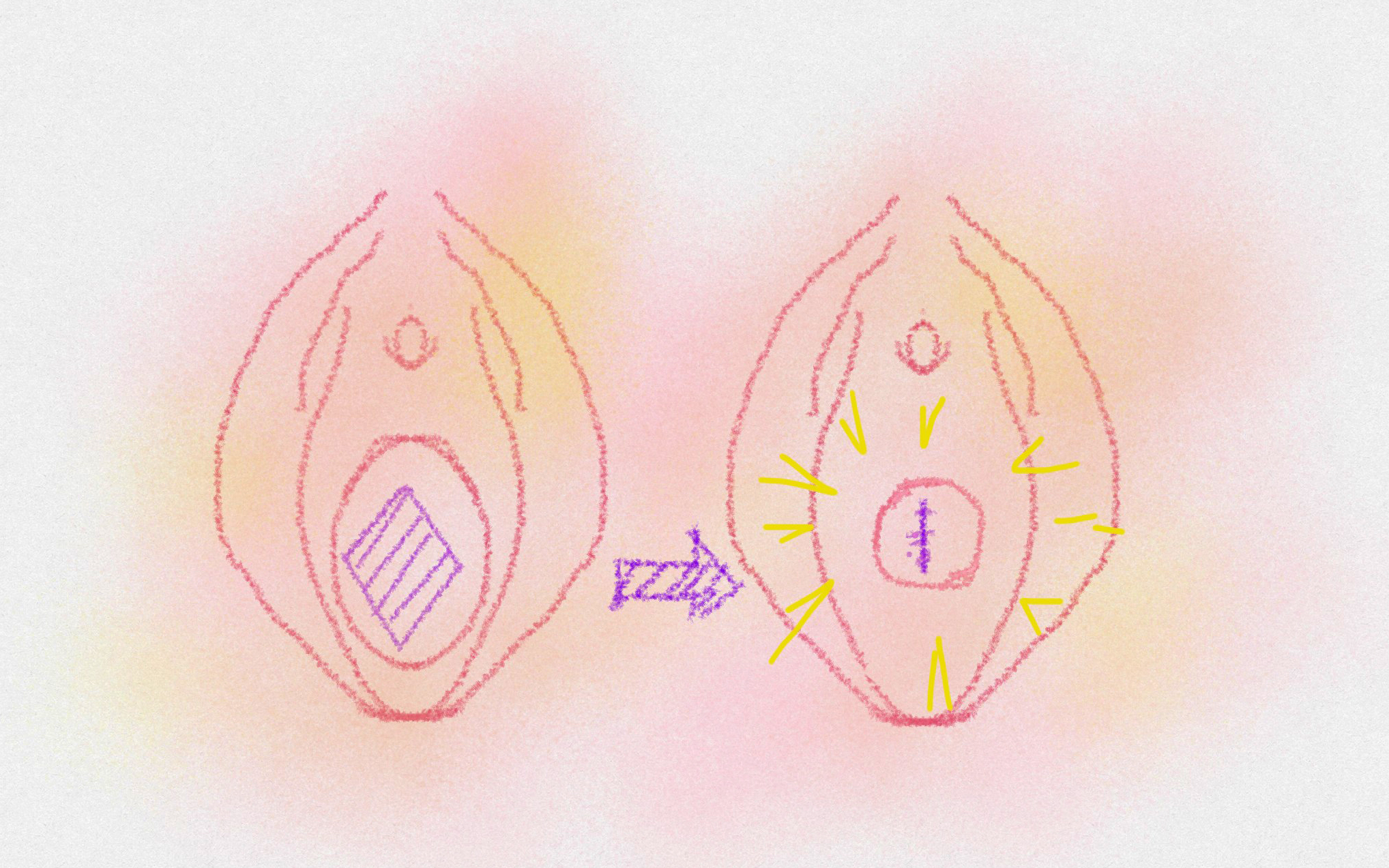 膣壁縮小イメージ