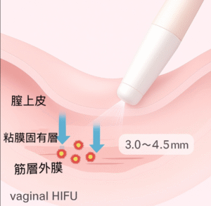 HIFU照射の断面イメージ