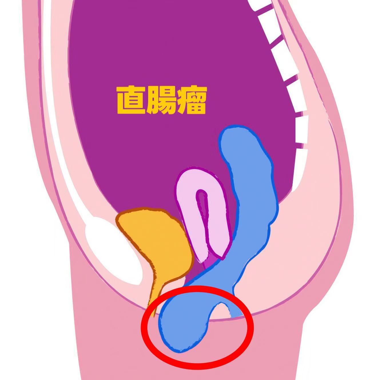 直腸瘤の図解
